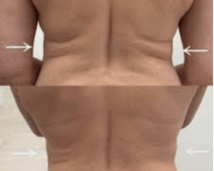 HIFU 14D PRO MAX CON LIPOSONIC : FLANCOS