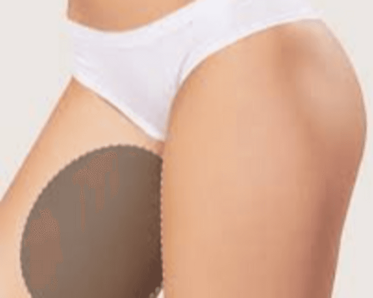 HIFU 14D PRO MAX CON LIPOSONIC : ENTREPIERNAS