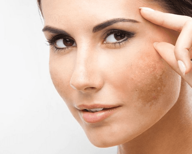 Facial despigmentante