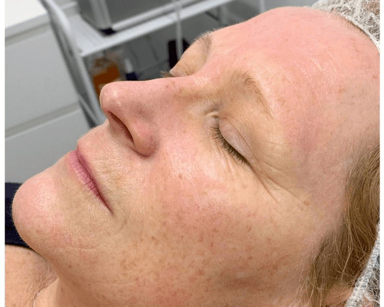 BIOLIFTING FACIAL PAQ 10