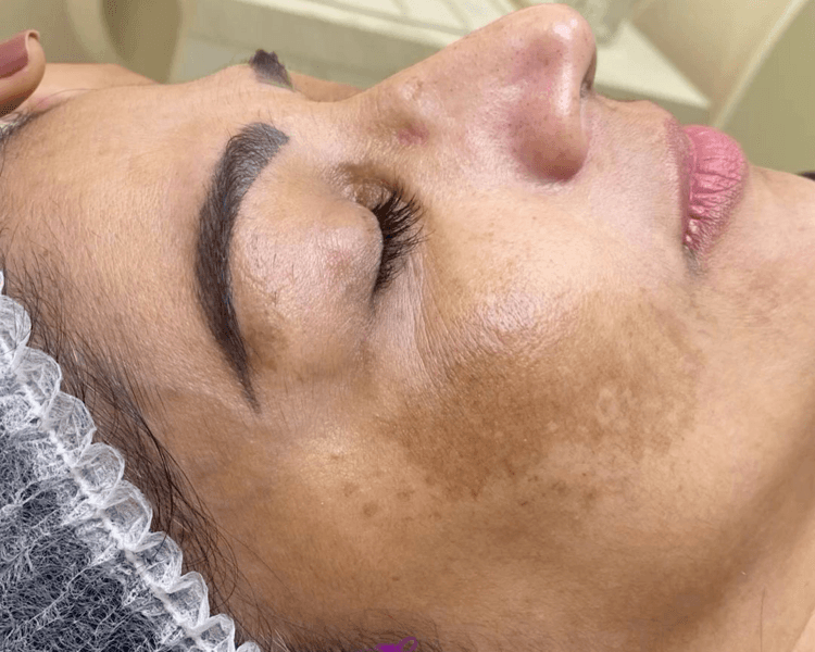 TRATAMIENTO REDUCCION DE MELASMA (PAÑO) 5
