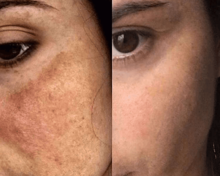 REDUCCION DE MELASMA (PAÑO)