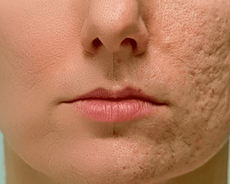 TRATAMIENTO SECUELAS Y MANCHAS DE ACNE 5