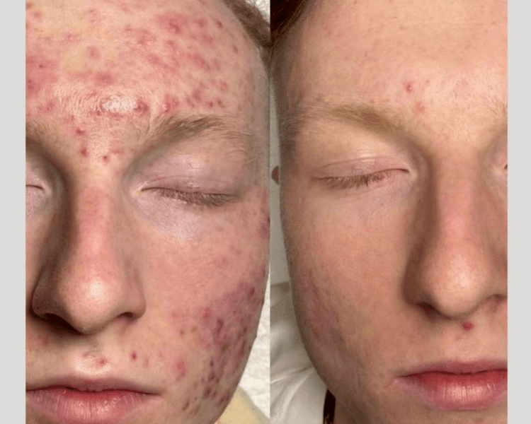 TRATAMIENTO CONTROL DE ACNE 5