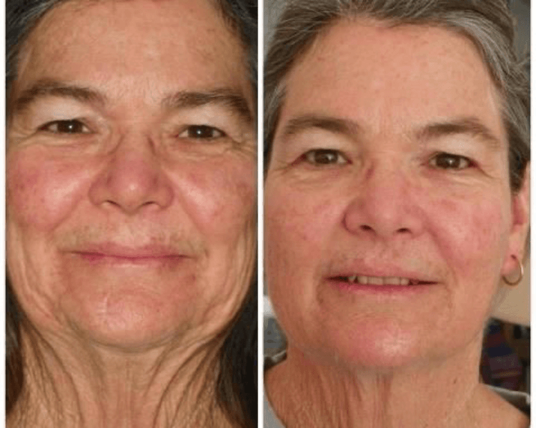 TRATAMIENTO ANTI EDAD