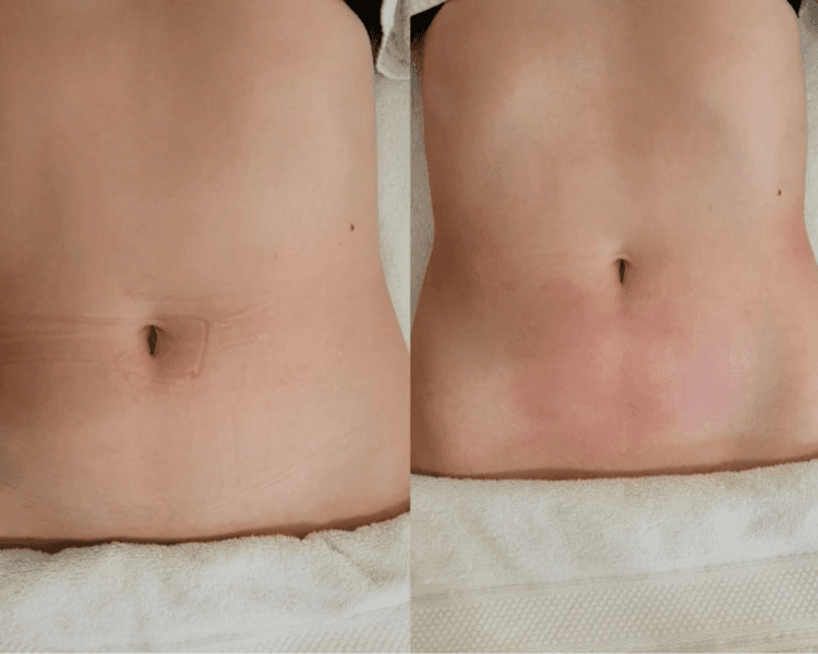 MADEROTERAPIA REDUCTIVA