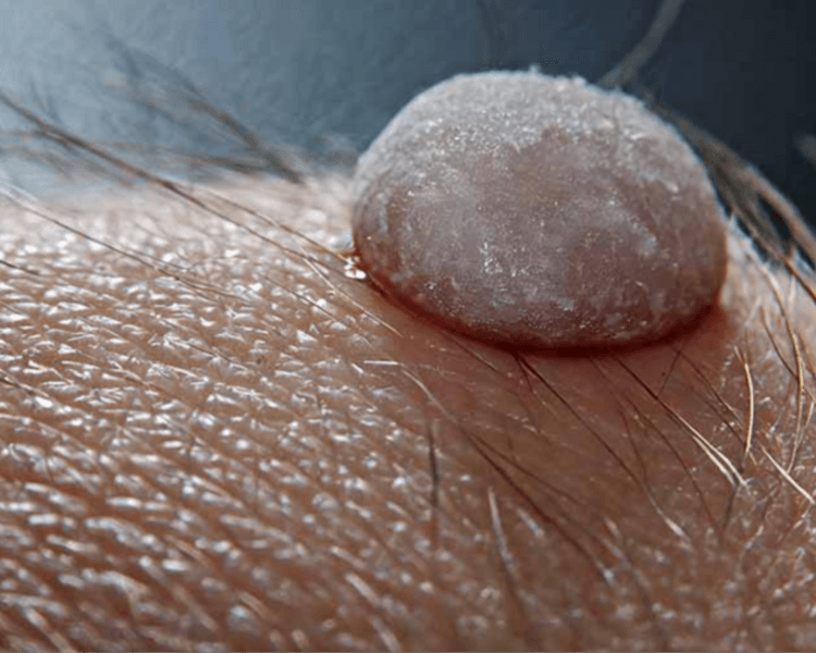 RETIRO VERRUGAS ZONA INTIMA