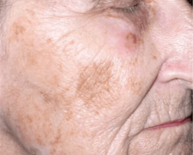 REDUCCION DE LENTIGO SENILES