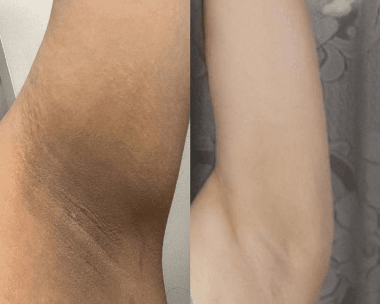 BLANQUEAMIENTO AXILAS 5