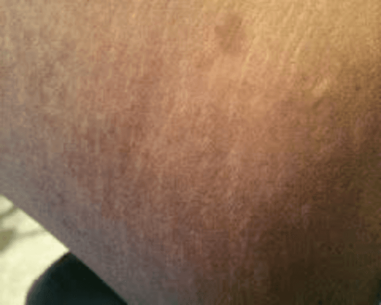 BLANQUEAMIENTO ENTREPIERNA 5