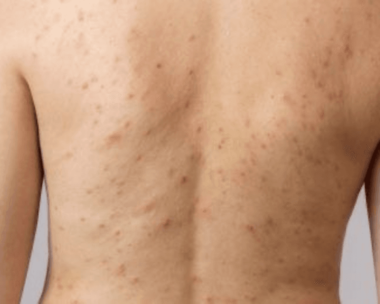 EXFOLIACION DE ESPALDA