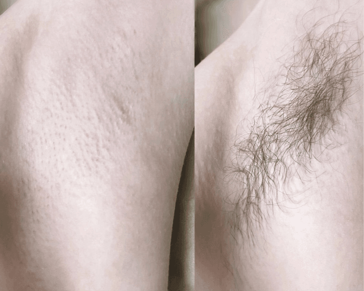 DEPILACION DE AXILAS