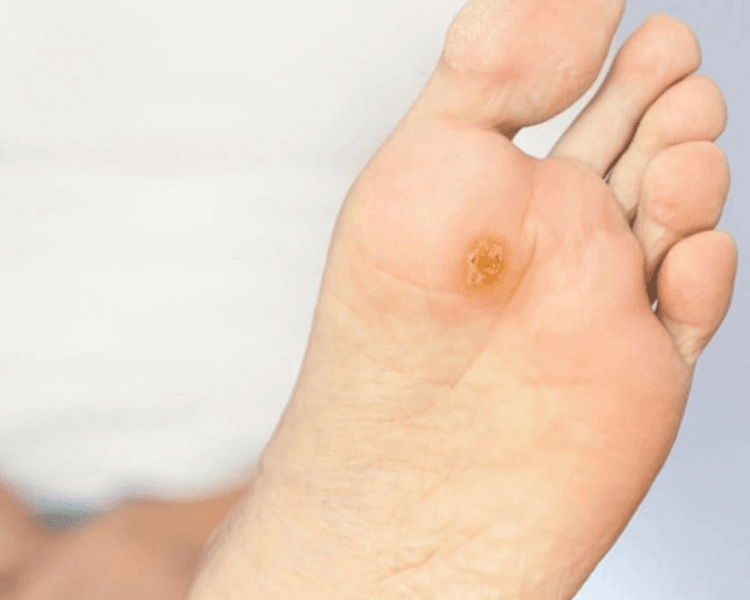 Podología Clínica Pie Diabético