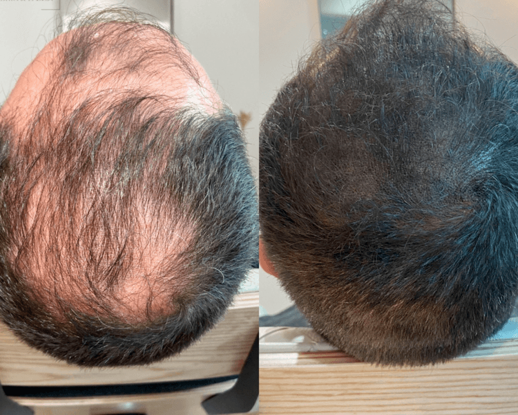 Efecto Densidad - Tricopigmentación