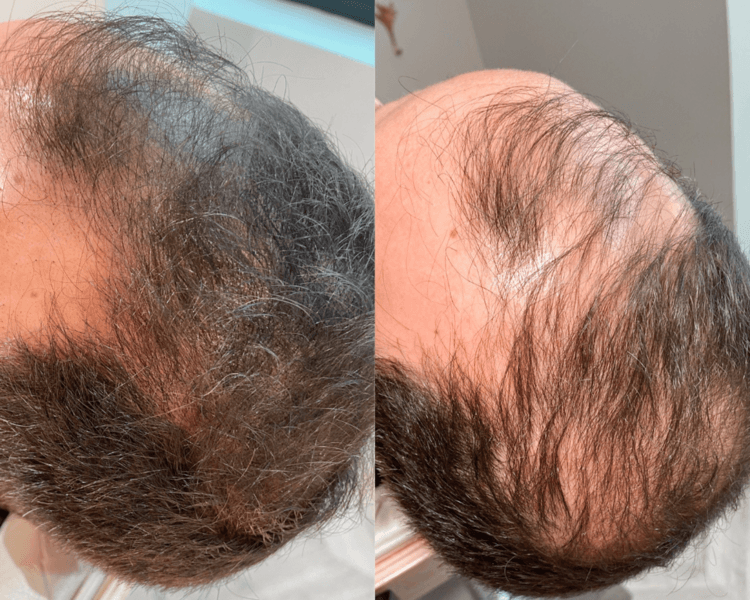 Efecto Densidad - Tricopigmentación