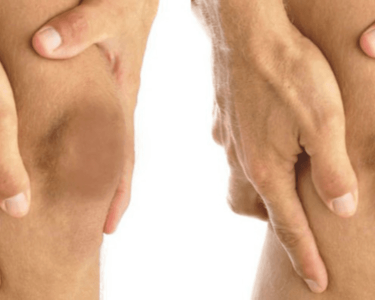 Aclaramiento de Rodillas - sesión