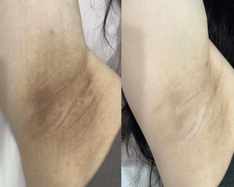 Aclaramiento Permanente de Axilas- sesión