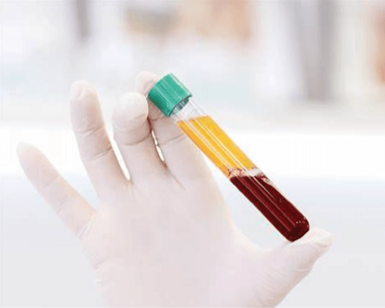 PLASMA RICO EN PLAQUETAS