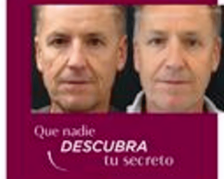 Bioestimulación Sculptra