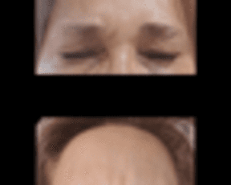 Toxina Botulínica 2 zonas