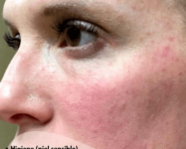 TRATAMIENTO PARA ROSÁCEA