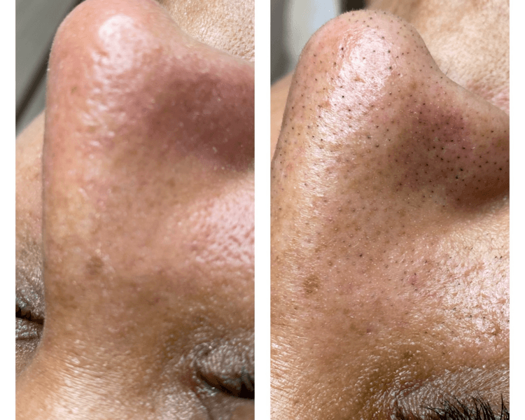 limpieza facial profunda premium