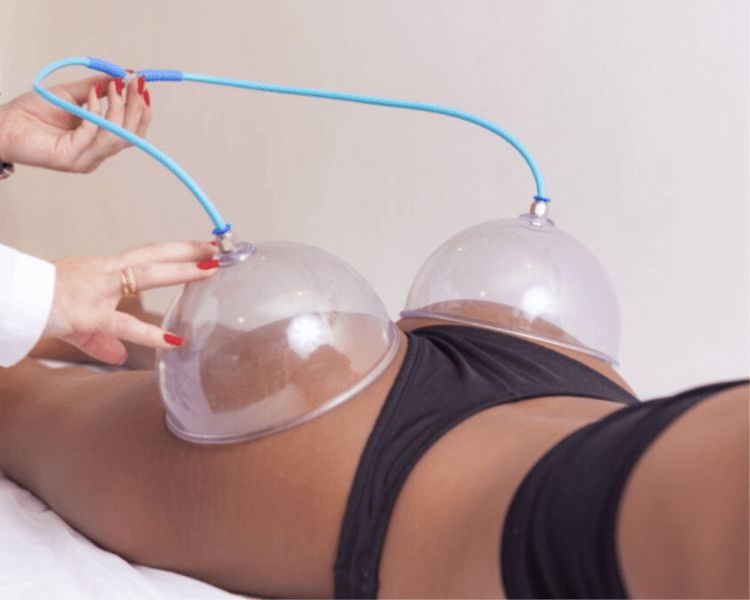 Voluminizacion de glúteos con copas