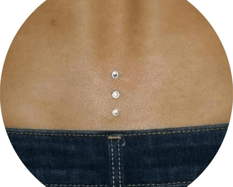 Lower back Microdermal x1 - Titanio grado implante