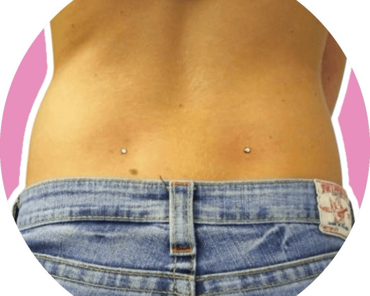 Lower back Microdermal x2 - Titanio grado implante