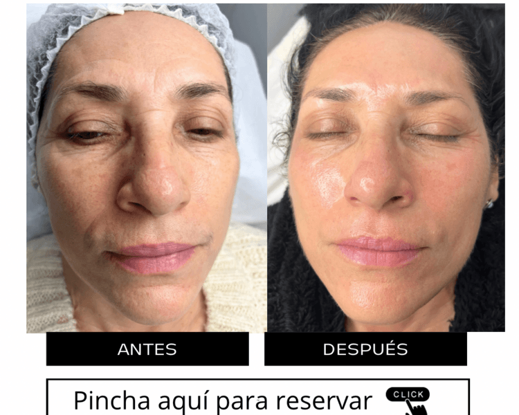 limpieza profunda + peeling quimico mesoestetic