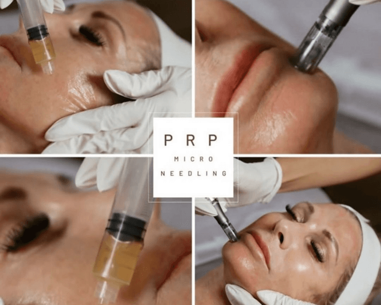 plasma rico en plaquetas