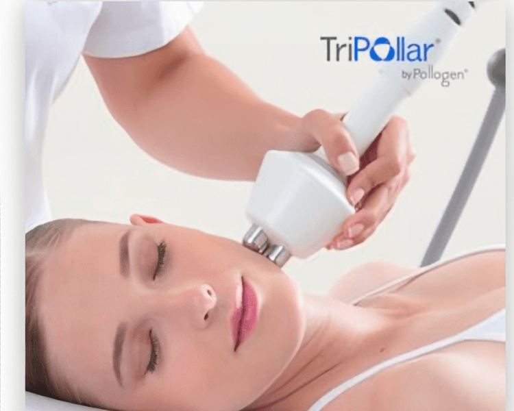 tripollar facial (radiofrecuencia pollogen )