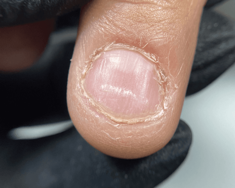 Micro extensión onicofagia (uñas mordidas)