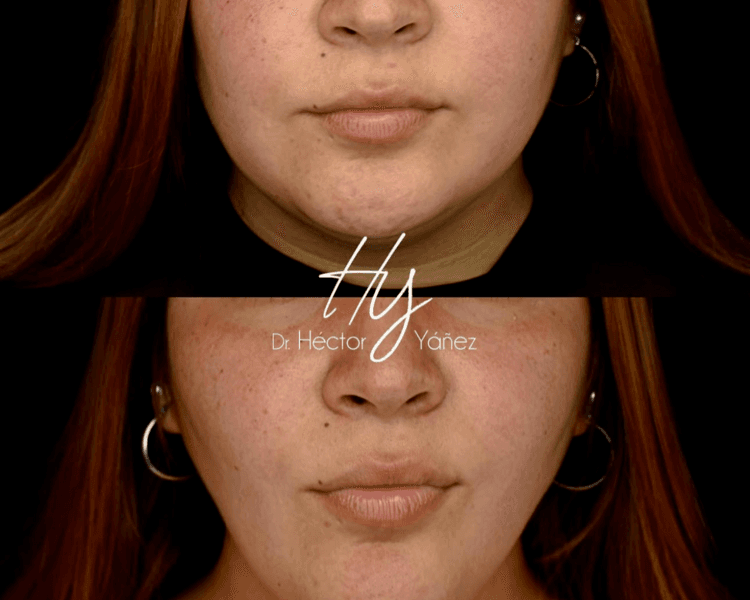 Bichectomía (Incluye Controles + Cirugía)