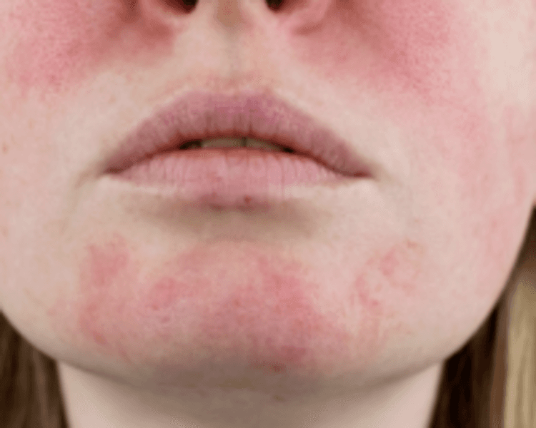 TRATAMIENTO FACIAL VASCULAR PARA ROSACEA