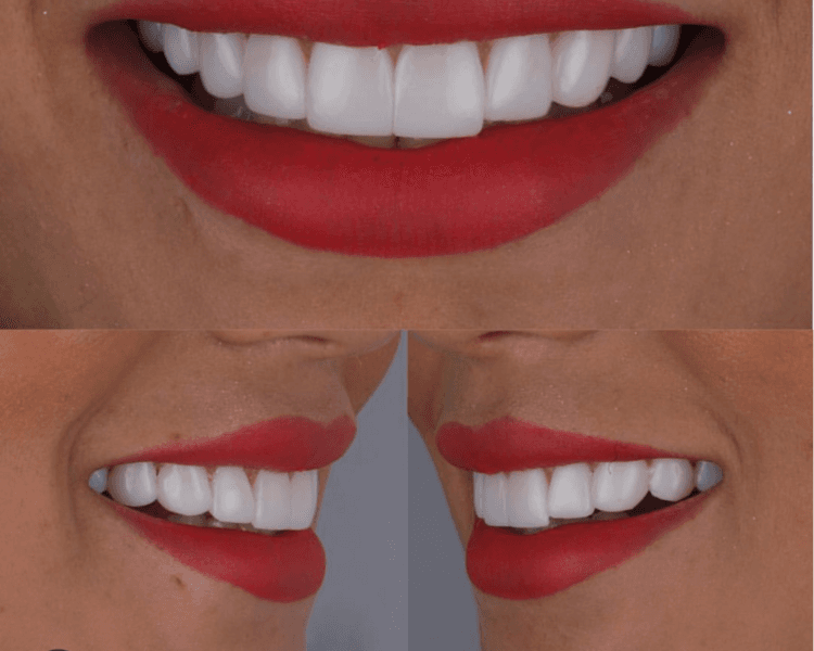 Diseño de Sonrisa (20 carillas)