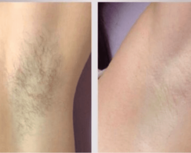 Depilación Progresiva Zona Mediana