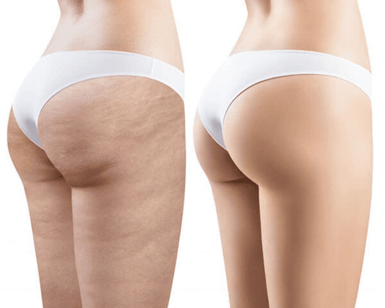 ANTI CELULITIS PACK 12