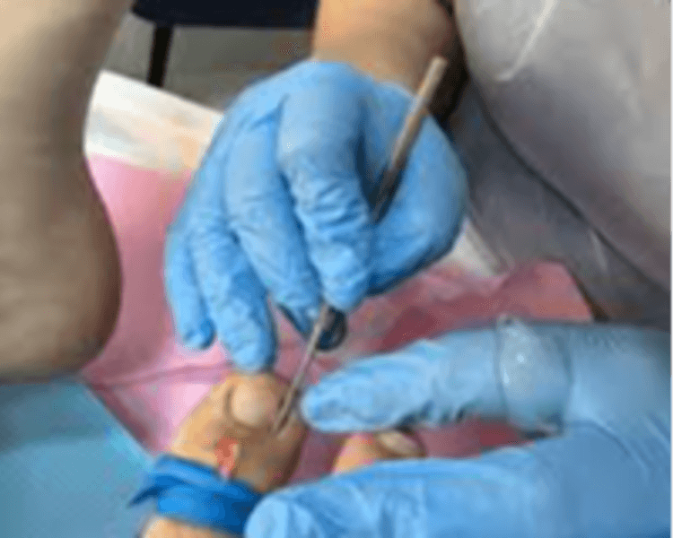 Podología Clínica Avanzada con uña encarnada