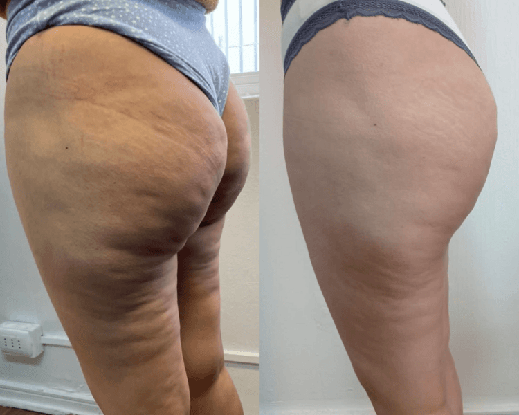 tratamiento anticelulitico mixto tripollar + tecnicas