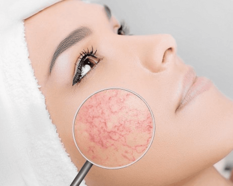 Limpieza facial trat. rosacea