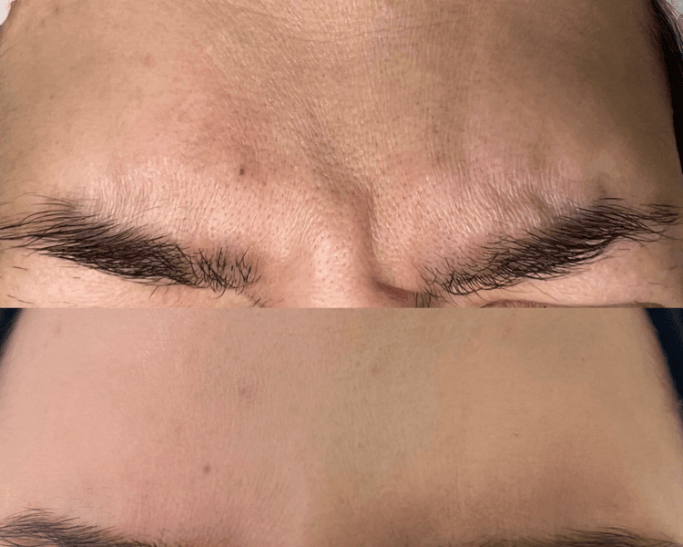 Toxina Botulínica (2 zonas)