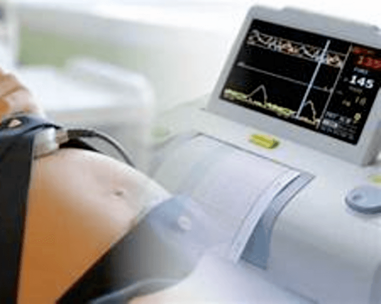 MONITOREO FETAL ELECTRONICO (RBNS)COD.2603001