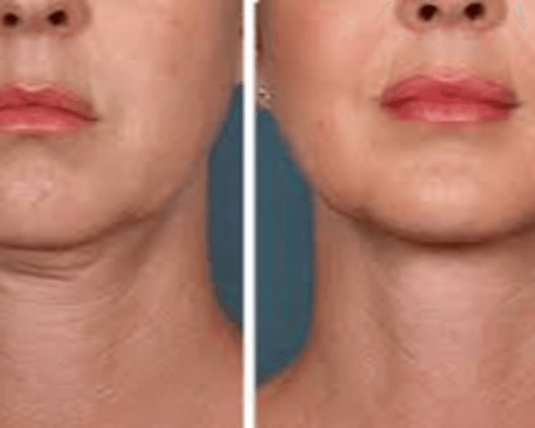 HIFU 14D PRO MAX FACIAL : ROSTRO Y PAPADA