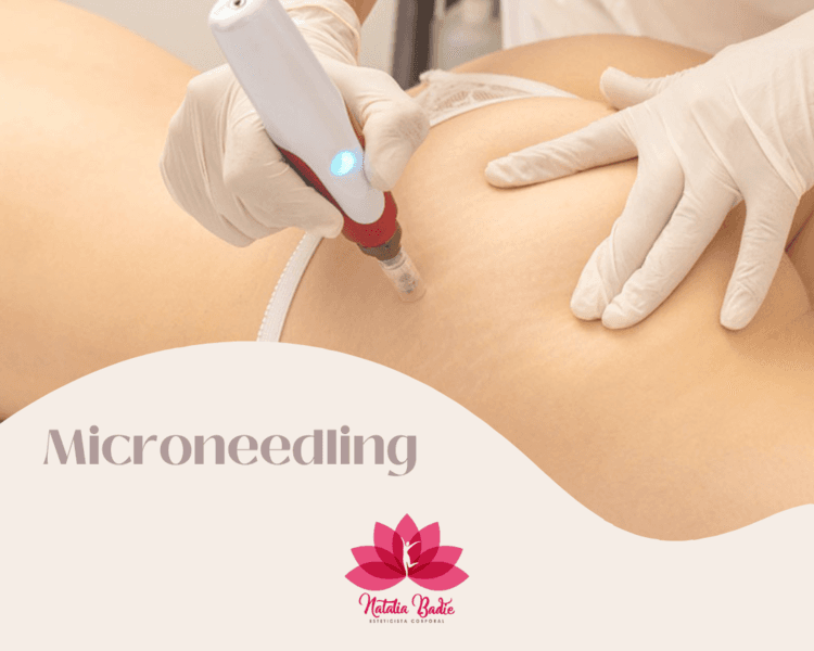 Microneedling Corporal