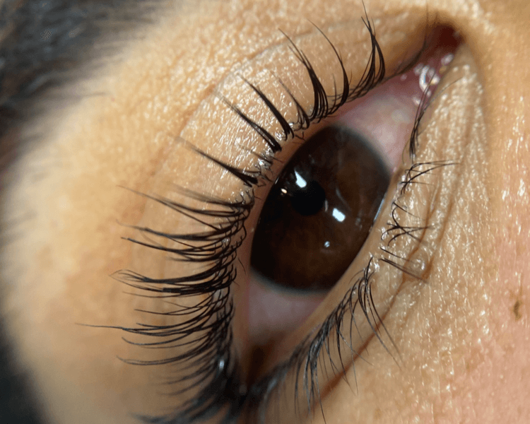 Reversión de lifting