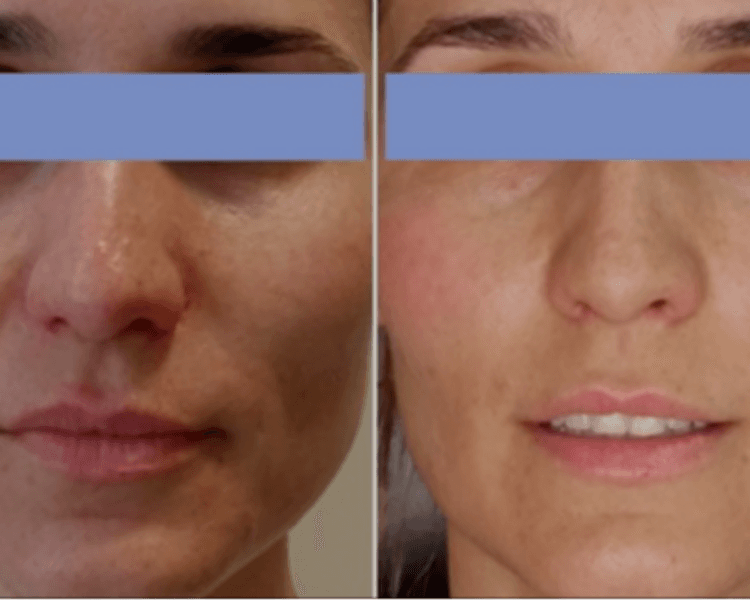 BIOESTIMULADOR FACETEM 1 jeringa