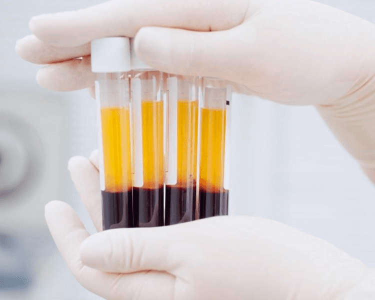 PLASMA RICO EN PLAQUETAS 3 SESIONES