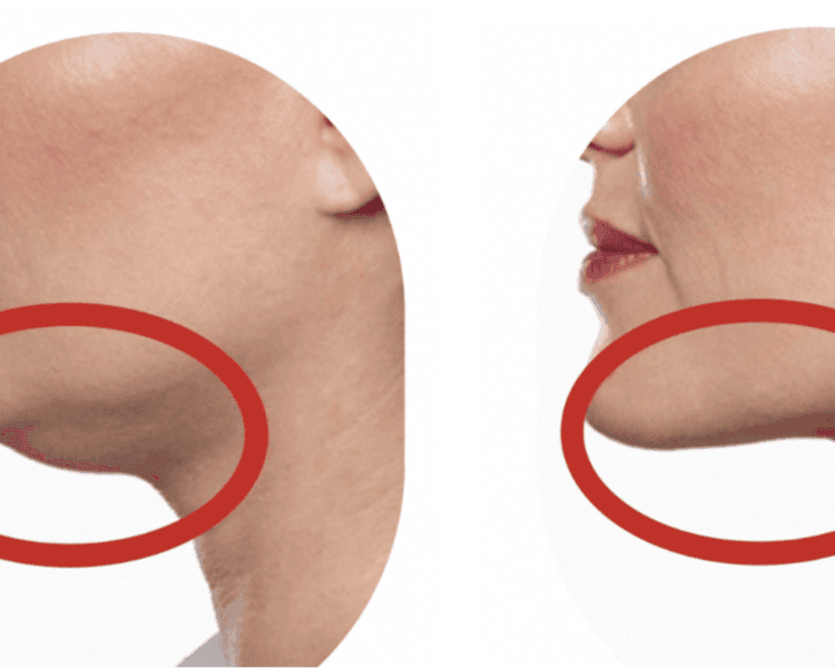 Lipopapada + marcacion