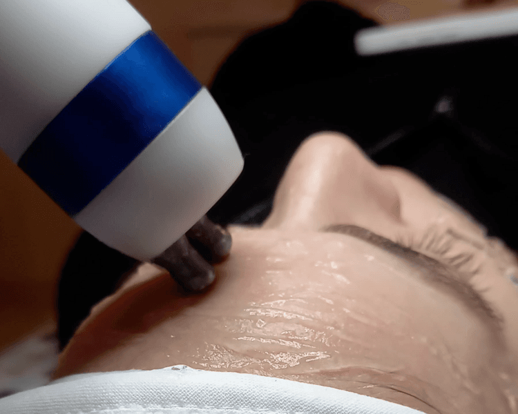 CRIORADIOFRECUENCIA FACIAL, CUELLO Y ESCOTE CON MESOTERAPIA